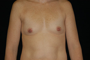 Breast Augmentation 6a